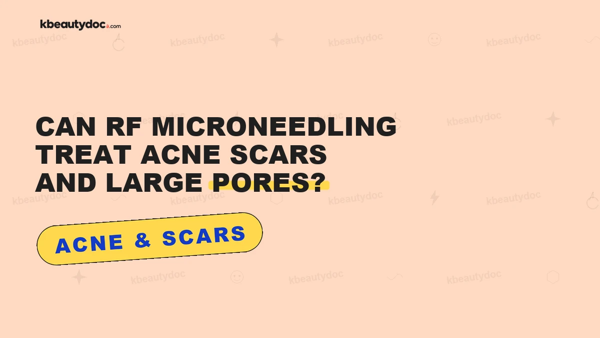 Can RF Microneedling Treat Acne Scars and Large Pores?