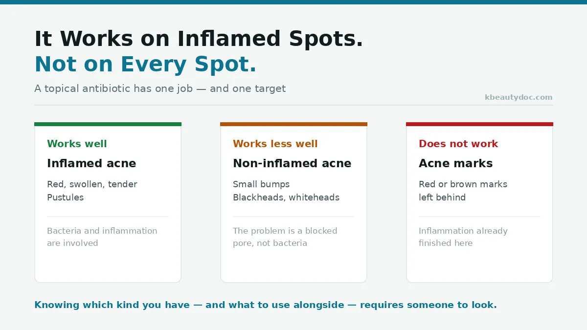 Which kinds of acne topical clindamycin actually works on