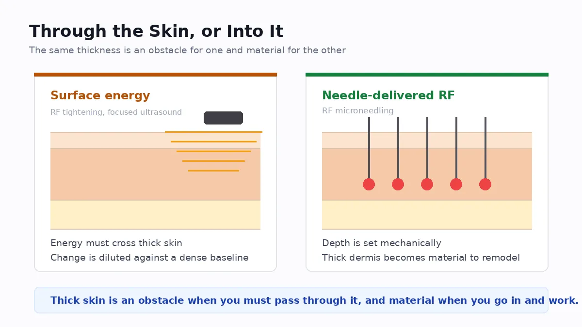 Why needle-delivered RF bypasses the thickness problem