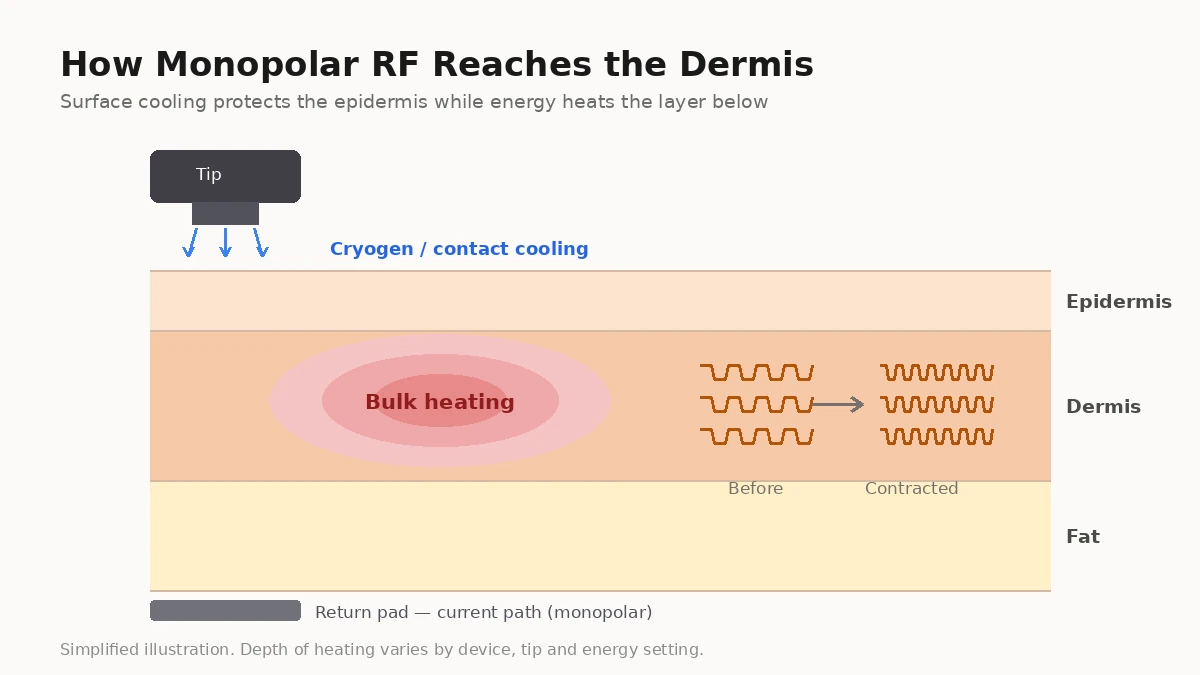 Diagram showing how monopolar radiofrequency energy heats the dermis while the skin surface is cooled