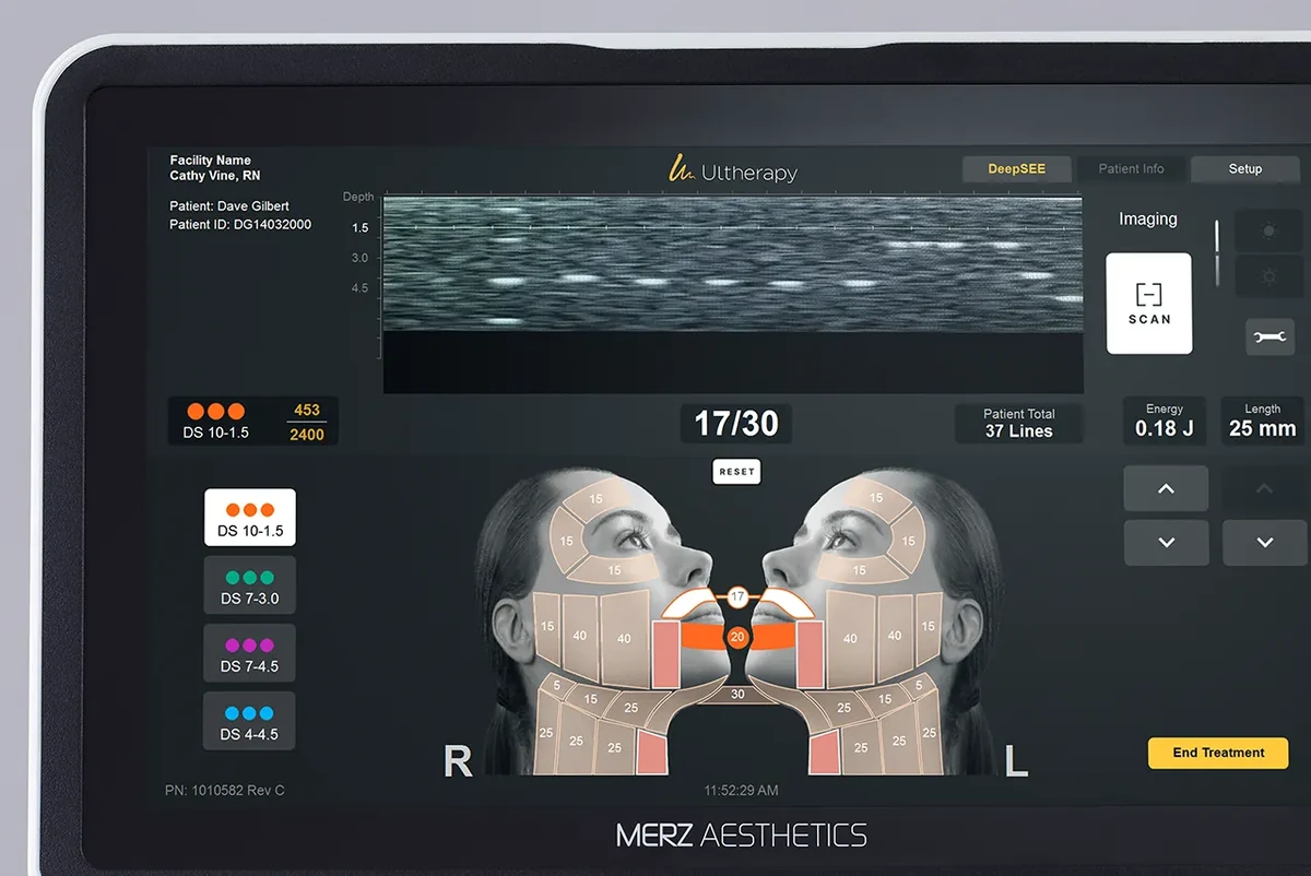 Ultherapy treatment screen showing a live grey ultrasound picture of the skin layers with depth marks at 1.5, 3.0 and 4.5 mm